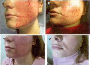 etapas de la restauración de la piel después del procedimiento de ablación fraccionada