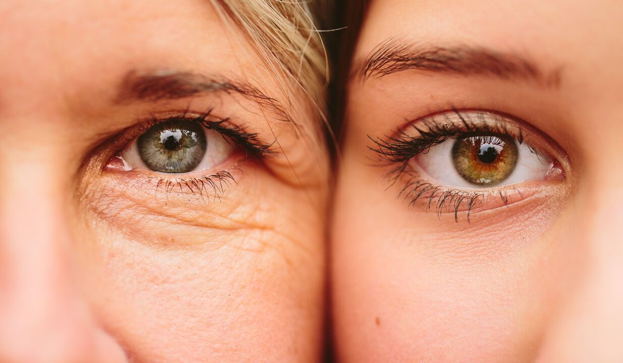 signos de envejecimiento alrededor de los ojos