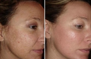 rejuvenecimiento de la piel de la cara con láser fotos antes y después